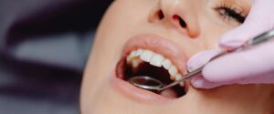 Mirlolisi dentale